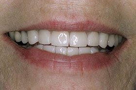 Paling-After-2-2_Veneers-Crowns-375x230_280wx185h