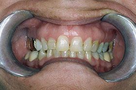 Paling-Before_Veneers-Crowns-375x230_280wx185h