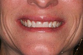 Pasqualis-After_Whitening-375x230_280wx185h