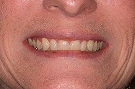 Pasqualis-Before_Whitening-375x230_280wx185h