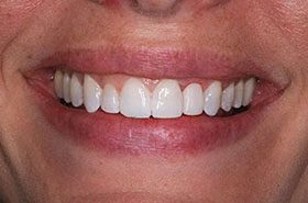 Perkins-After_Bonding-375x230_280wx185h
