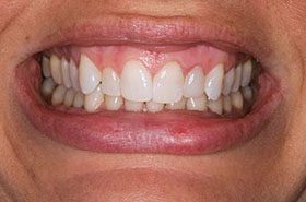 Perkins-Before_Bonding-375x230_280wx185h