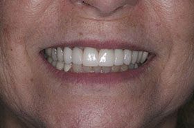 Pierce-After-Uppers_Veneers-Crowns-375x230_280wx185h