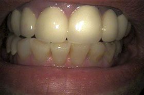 Pierce-Before-1_Veneers-Crowns-375x230_280wx185h