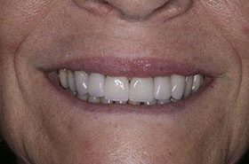 Puhls-Barbara-After_Veneers-Crowns-375x230_280wx185h