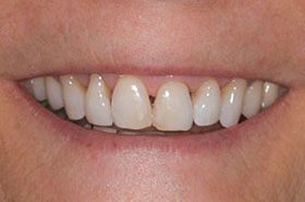 Puhls-Barbara-Before_Veneers-Crowns-375x230_280wx185h