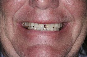 Puhls-Before_Veneers-Crowns-375x230_280wx185h