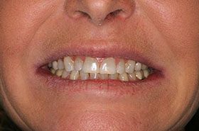 Ray-Before_Whitening-375x230_280wx185h