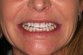Ray-after_Whitening-375x230_280wx185h
