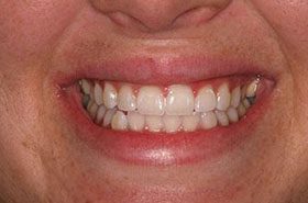 Reagan-After_Whitening-375x230_280wx185h