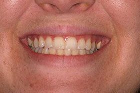 Reagan-Before_Whitening-375x230_280wx185h