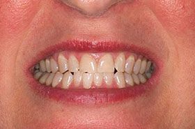 Robin-Afyter_Whitening-375x230_280wx185h