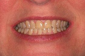 Robin-Before_Whitening-375x230_280wx185h