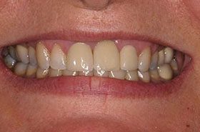 Rogers-After_Bonding-375x230_280wx185h
