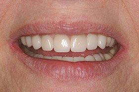 Romine-After-1_Veneers-Crowns-375x230_280wx185h