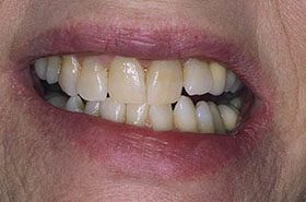 Romine-Before_Veneers-Crowns-375x230_280wx185h