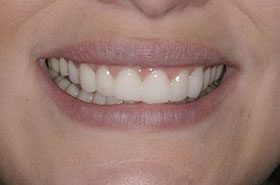 Salyon-After_Veneers-Crowns-375x230_280wx185h
