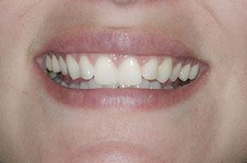 Salyon-Before_Veneers-Crowns-375x230_280wx185h