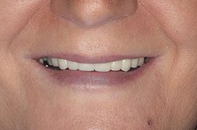 Sanford-After_Veneers-Crowns-375x230_280wx185h