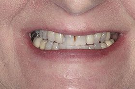 Sanford-Before_Veneers-Crowns-375x230_280wx185h