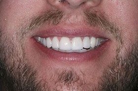 Schultz-Aftert_Veneers-Crowns-375x230_280wx185h