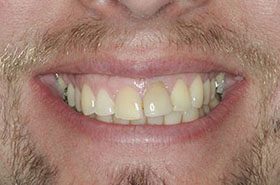 Schultz-Before_Veneers-Crowns-375x230_280wx185h