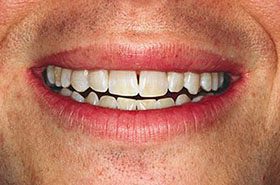 Schwartz-After_Whitening-375x230_280wx185h