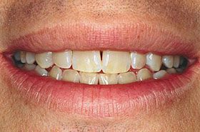 Schwartz-Before_Whitening-375x230_280wx185h