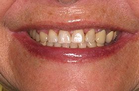 Scott-After_Whitening-375x230_280wx185h