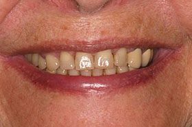 Scott-Before_Whitening-375x230_280wx185h