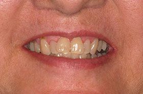 Seifert-Before_Whitening-375x230_280wx185h