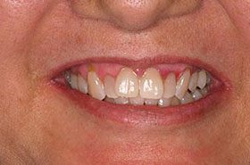 Siefert-After_Whitening-375x230_280wx185h