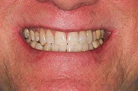 Smith-After_Whitening-375x230_280wx185h
