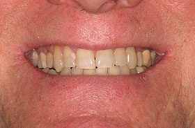 Smith-Beforre_Whitening-375x230_280wx185h