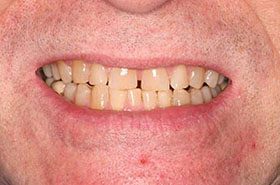 Stauffer-Before_Whitening-375x230_280wx185h