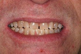 Staufferv-cAfter_Whitening-375x230_280wx185h