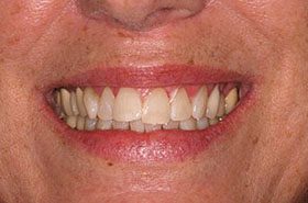 Stepp-After_Whitening-375x230_280wx185h