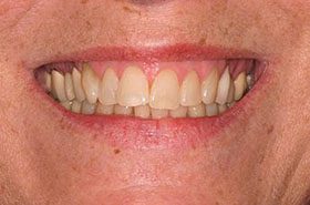 Stepp-Before_Whitening-375x230_280wx185h