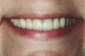 Storms-After_Veneers-Crowns-375x230_280wx185h