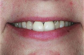 Storms-Before_Veneers-Crowns-375x230_280wx185h