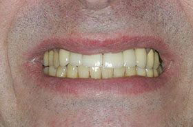 Storms-Ralph-After_Veneers-Crowns-375x230_280wx185h