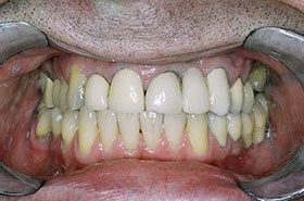 Storms-Ralph-Bafore_Veneers-Crowns-375x230_280wx185h