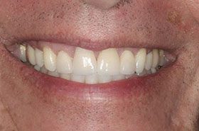 Strauss-After_Veneers-Crowns-375x230_280wx185h