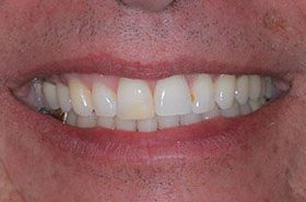 Strauss-Before_Veneers-Crowns-375x230_280wx185h