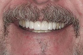 Temple-After_Veneers-Crowns-375x230_280wx185h
