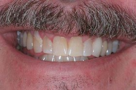 Temple-Roger-Before_Veneers-Crowns-375x230_280wx185h