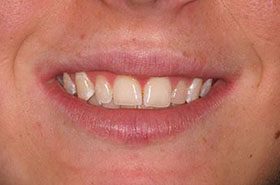 Unk-After_Whitening-375x230_280wx185h