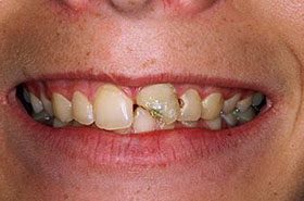 Vanorum-Before-1_Bonding-375x230_280wx185h
