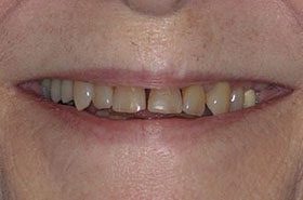 Wallace-Before_Veneers-Crowns-375x230_280wx185h