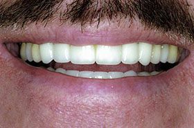Weaver-After_Veneers-Crowns-375x230_280wx185h